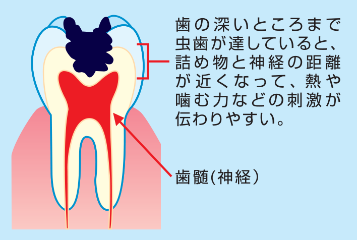 歯の深いところまでむし歯が達してしまっていると、詰めものと神経の距離が近くなって、噛んだ時の力や熱などによる刺激が神経に伝わりやすい。