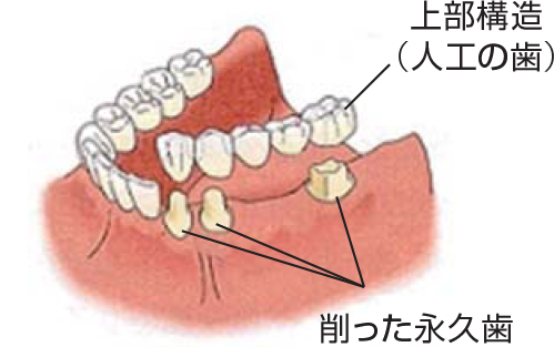 ブリッジ