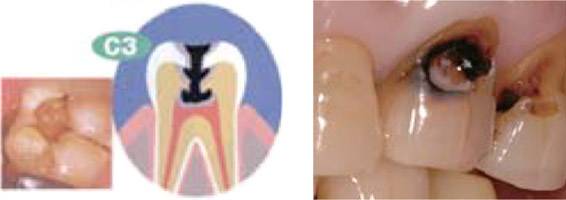 C3むし歯がエナメル質、象牙質を貫通し神経にまで達した状態