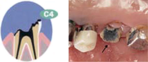C4虫歯が歯全体に進行している状態