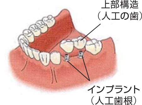 インプラント