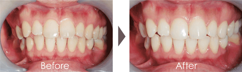 beforeafter