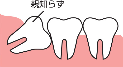 横に出てきた親知らず