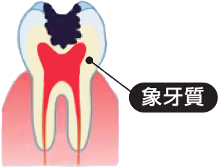 1.　大きなむし歯がある場合やむし歯を削った後