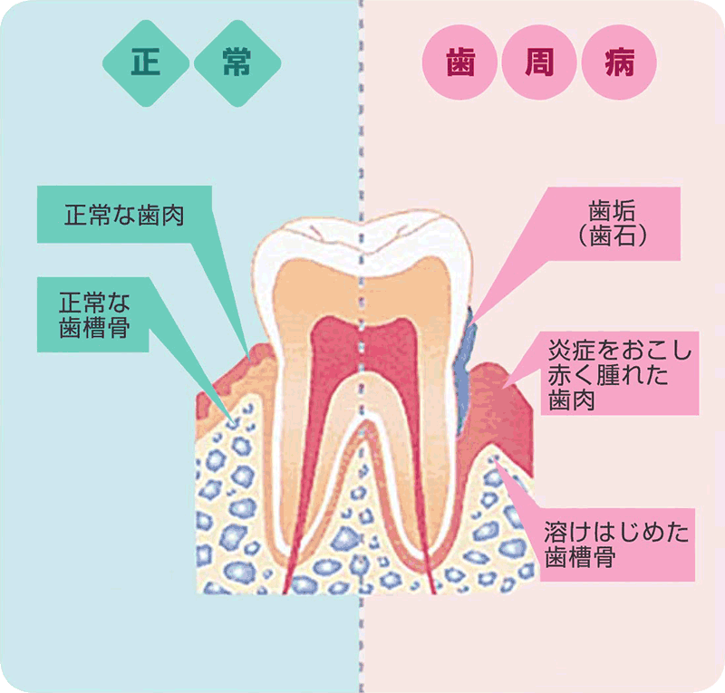 正常な歯と歯周病の違い