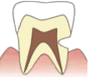 エナメル質や象牙質が削れている状態