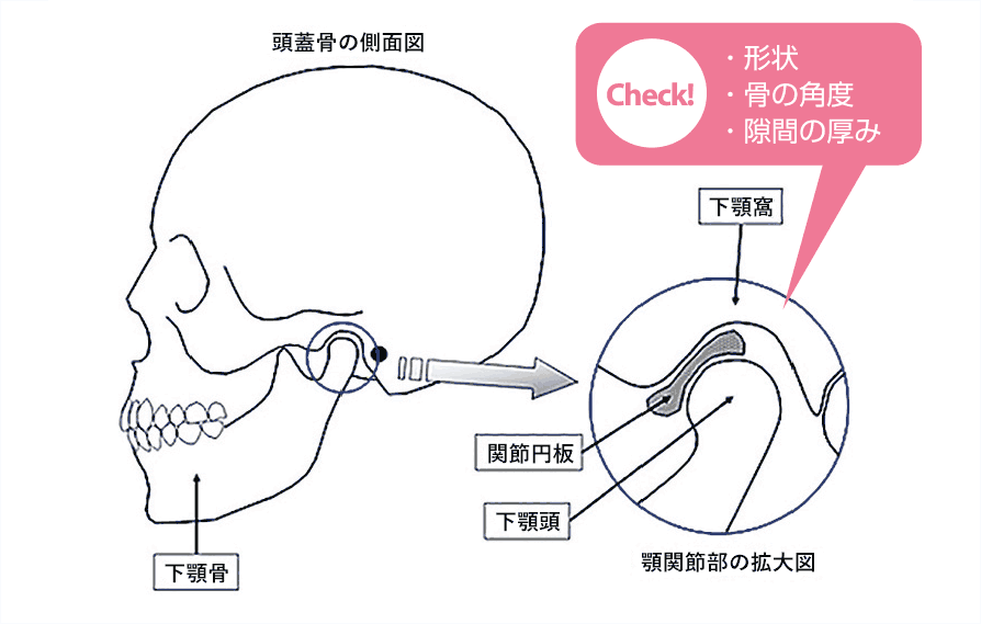 顎関節CT検査