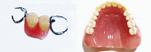 欠損した歯の治療 保険治療