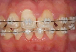 歯列矯正・ホワイトニング 保険治療