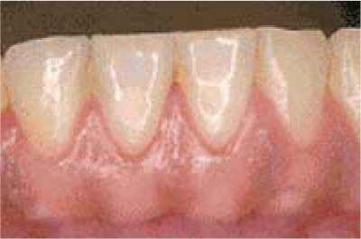 軽度の歯周病（写真）
