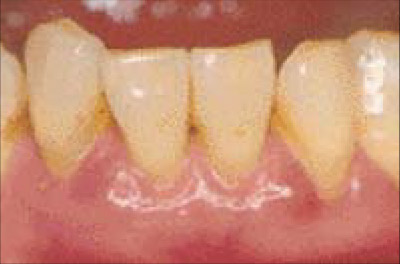 中程度の歯周病（写真）