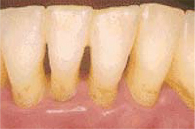 重度の歯周病（写真）