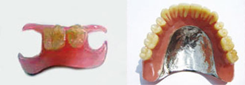 欠損した歯の治療 自費治療