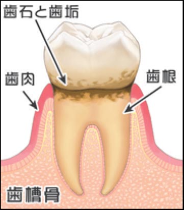 1.歯周ポケットに歯垢が溜まり、硬い歯石に変化してきています。