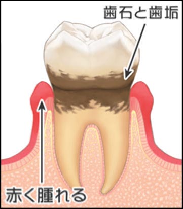 2.固まった歯石の上にさらに歯垢が溜まって、また歯石に変化し、だんだん範囲も広がってきます。