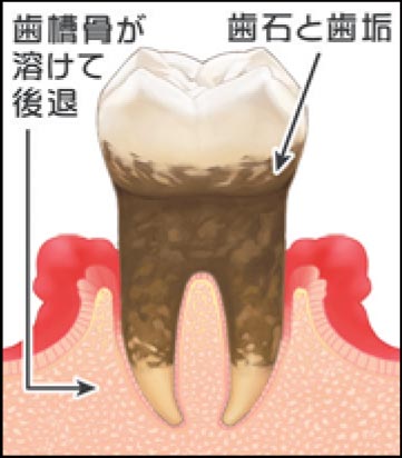 3.歯ぐきに炎症を起こした菌が歯槽骨にまで達し、歯槽骨が溶け始めて、歯ぐき自体が下がってきます。