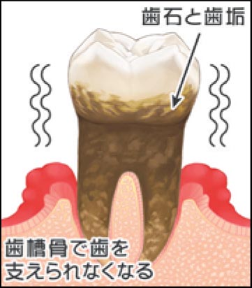 4.歯槽骨が溶けて不十分になると、歯を支えられなくなり、歯が抜けてしまうことがあります。